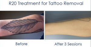 The R20 Technique: The Best Laser Tattoo Removal in NYC