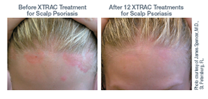 XTRAC: The new psoriasis light treatment - Schweiger Dermatology