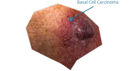 Sample Skin Cancer