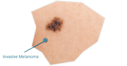 Sample Skin Cancer