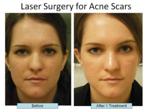 Before and after 1 treatment images of female patient who successfully underwent Laser Surgery for Acne Scars.