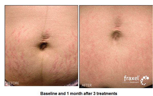 Stretch Mark Removal - Pulse Light Clinic London