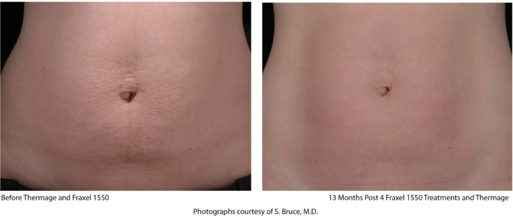 stretch marks laser treatment