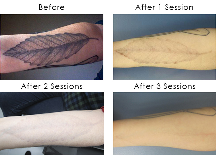 Laser Tattoo Removal - Schweiger Dermatology Group