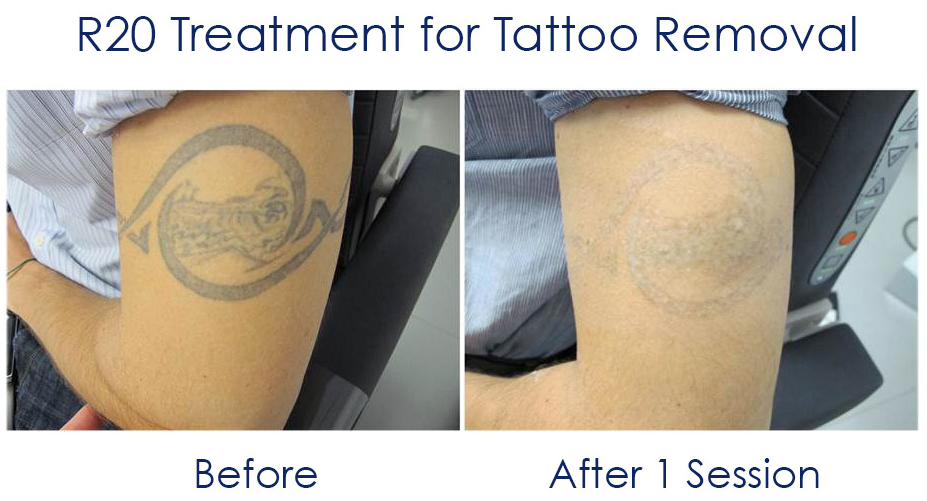 8. Hydrogen Peroxide Tattoo Removal: How Many Sessions Are Needed? - wide 2