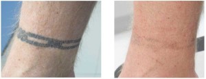 Tattoo Removal Cost  Schweiger Dermatology Group