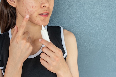 Acne condition evaluated by dermatologist during patient visit