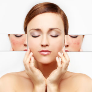 Schweiger Dermatology | rosacea
