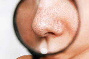 closeup view through a magnifying glass of blackheads on the nose