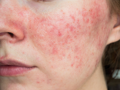Lady ready to get Rosacea treatment