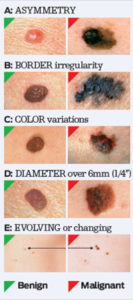 melanoma cancerous skin tags pictures melanoma cancerous skin tags pictures