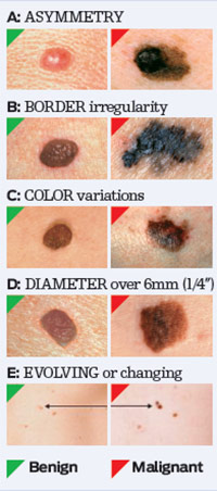 Skin cancer benign mole