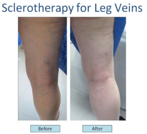 Before and after images of sclerotherapy leg vein treatment on the back side of the leg.