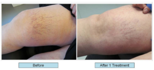 Before and after 1 treatment images of spider veins on legs.