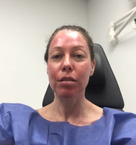 Microneedling treatment NYC