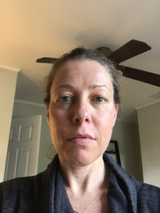 Microneedling treatment NYC.