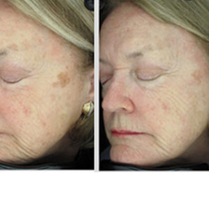 Clear & Brilliant Original before & after