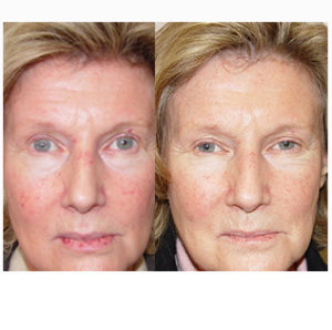 Scar Removal with Fractional CO2 Laser before & after