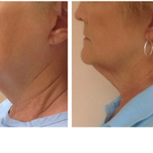 Ulthera before & after