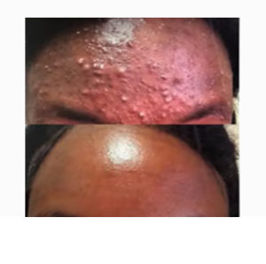 Fraxel Dual (1927 nm) before & after