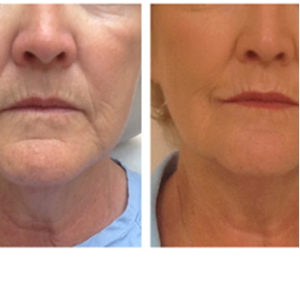Ulthera before & after