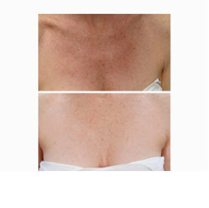 Fraxel Dual (1550 nm) before & after