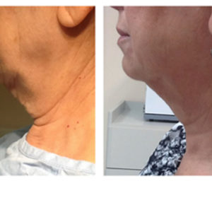 Ulthera before & after