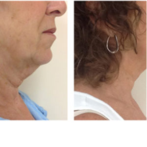 Ulthera before & after