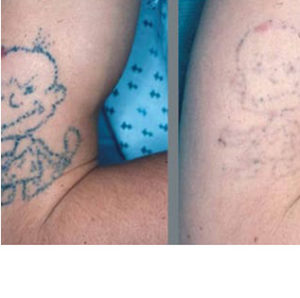 R20 Treatment for Tattoo Removal before & after