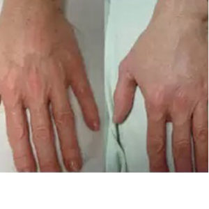 Hand Rejuvenation with Radiesse before & after