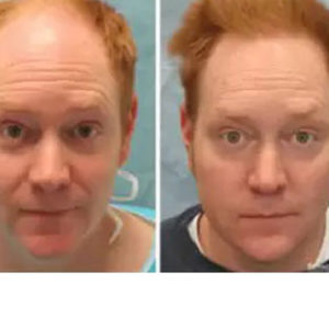 Hair Restoration before & after