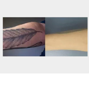 R20 Treatment for Tattoo Removal before & after