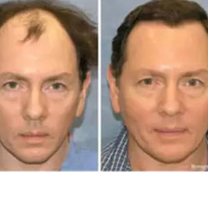 Hair Restoration before & after