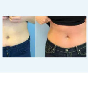 ZELTIQ Non-Surgical Fat Reduction before & after