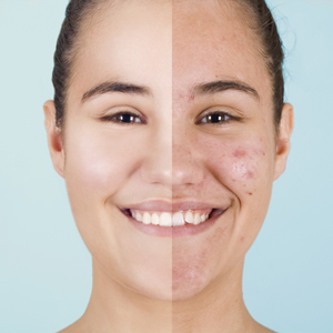 best laser for acne scars