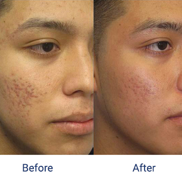 Before and after images of a male patient who successfully underwent acne scars laser resurfacing treatment on his right cheek.