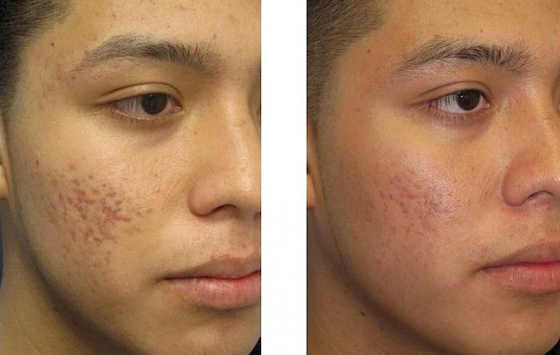 Acne Treatments NYC | Schweiger Dermatology Group