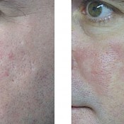 before and after images of best acne treatments - patient 5