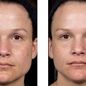 Before and after images of a female patient who successfully underwent laser resurfacing of her face - patient 3.