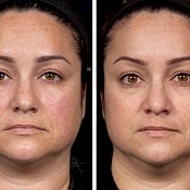 Before and after images of a female patient who successfully underwent laser resurfacing of her face - patient 1.