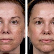 Before and after images of a female patient who successfully underwent laser resurfacing of her face - patient 2.