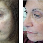 Before and after images of a female patient who successfully underwent fractional CO2 laser resurfacing on her left cheek and jawline.