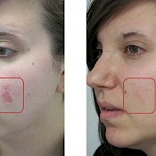 Before and after images of a female patient who successfully underwent fractional CO2 laser resurfacing on her left cheek.