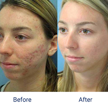 Before and after images of a female patient who successfully underwent laser treatment for her acne scars on her left cheek.