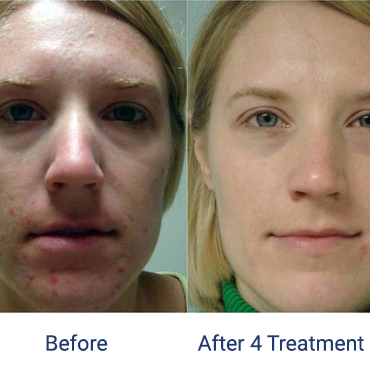 Before and after 4 treatment images of a female patient who successfully underwent laser therapy for acne on her face.