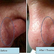 Before and after 1 treatment images of a nose vein removal.