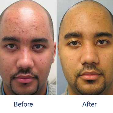 Before and after images of a male patient who successfully underwent laser treatment for acne on his face.