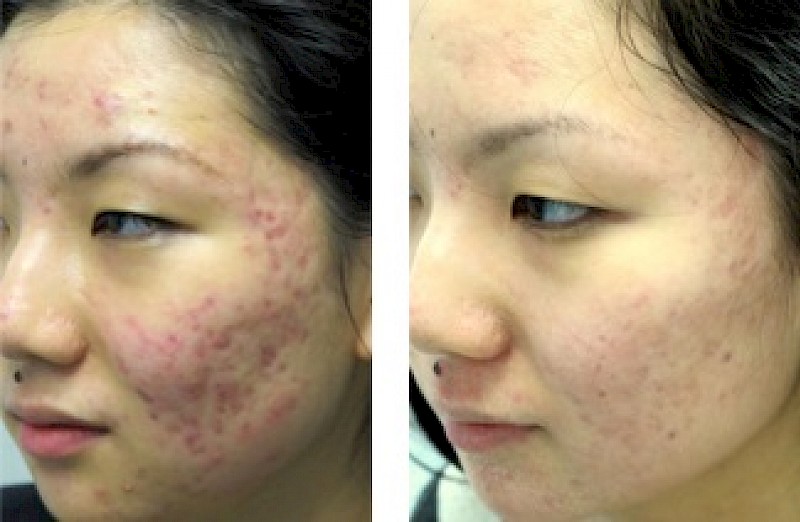 Photodynamic Therapy (PDT) Acne Treatment | Schweiger ...
