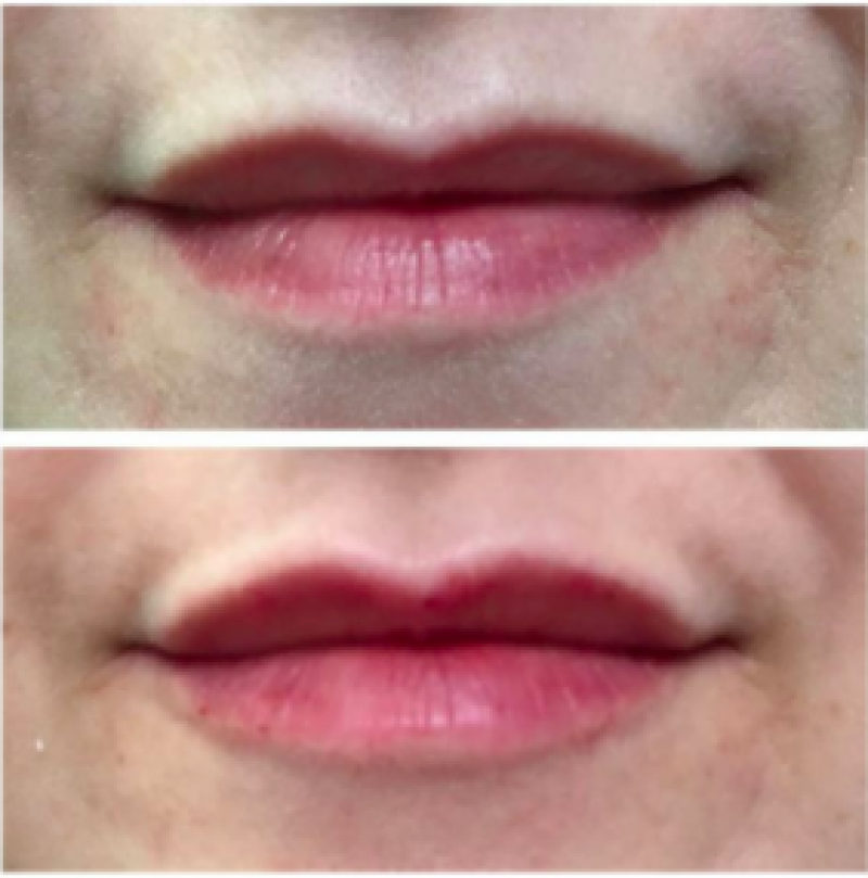 How Lip Fillers Work and What To Expect After
