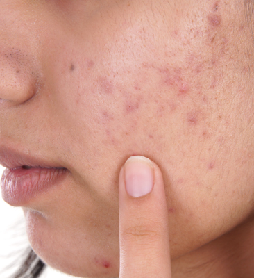 Acne Scarring Dermnet Nz Acne Scarring Dermnet Nz